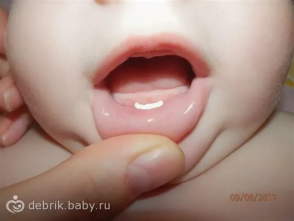 Прорезывание зубов мудрости фото десны Что это!??зубы?? - 26 ответов форум Babyblog