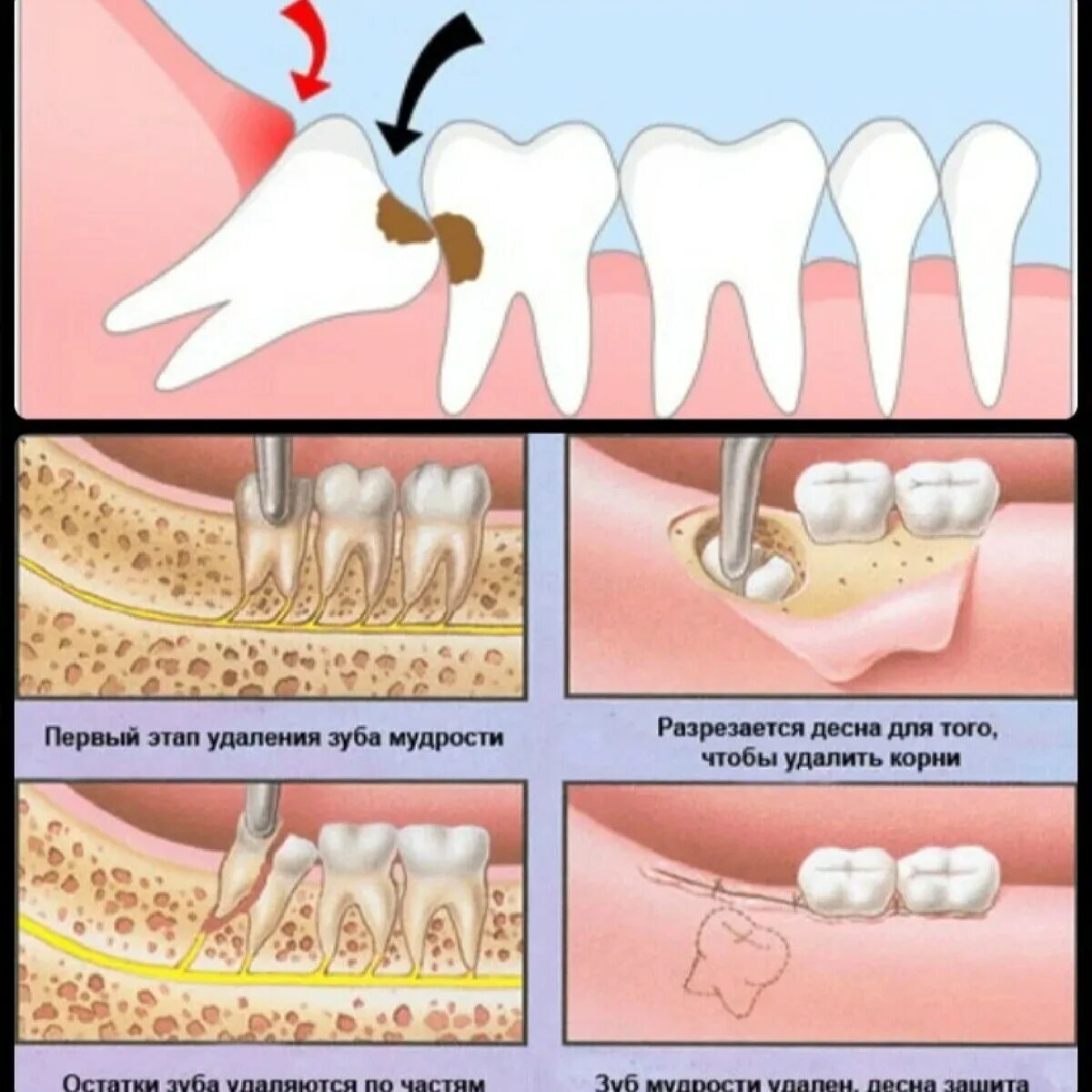 Прорезывающийся зуб мудрости фото Почему удаляют зубы мудрости