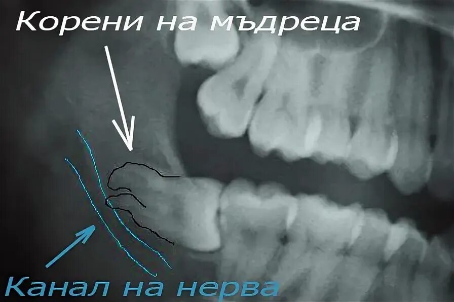 Прорезывающийся зуб мудрости фото Коренной зуб 8