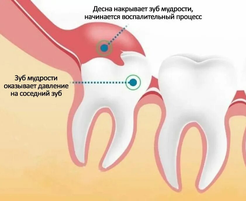 Прорезывающийся зуб мудрости фото Воспалилась десна около зуба мудрости - Стоматология в Томске