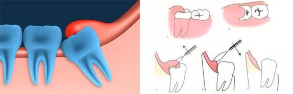 Прорезывающийся зуб мудрости фото Вырвать зуб в спб недорого - найдено 80 картинок