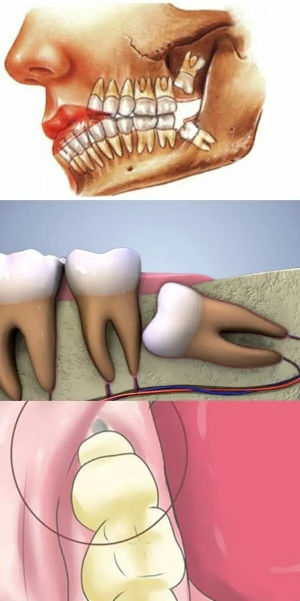 Прорезывающийся зуб мудрости фото Признаки зуба мудрости Стоматология в Москве "СТАЙЛ-С"