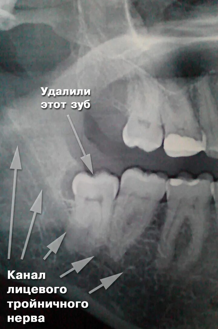 Прорезывающийся зуб мудрости фото Зуб мудрости на картинке