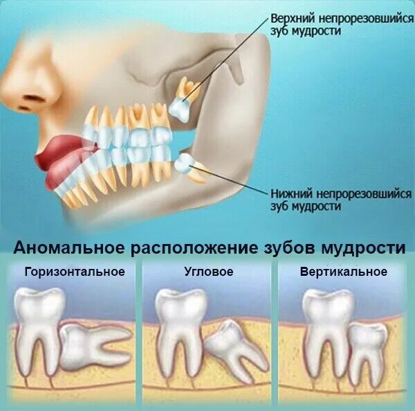 Прорезывающийся зуб мудрости фото Что делать после удаления зуба мудрости? О здоровье простыми словами. Альфа-стом