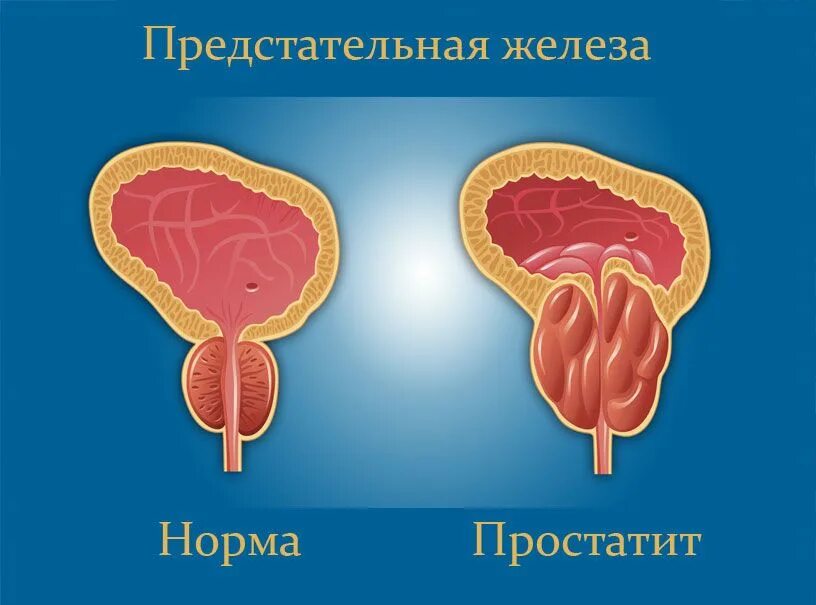 Простата это простыми словами фото у мужчин Хронический простатит - стоит ли бояться? Клиника Радуга