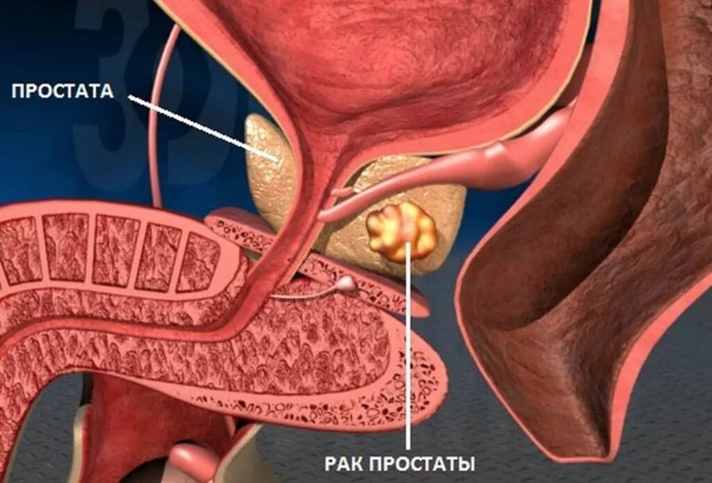 Простата это простыми словами фото у мужчин Рак простаты - диагностика и лечение в клинике Москвы, метро Курская и Чкаловска