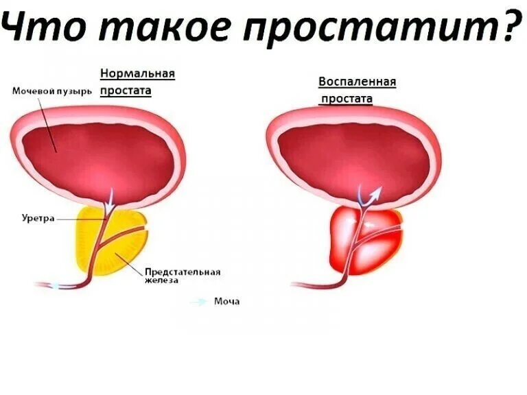 Простата это простыми словами фото у мужчин КАК ПРЕДОТВРАТИТЬ РЕЦИДИВ ПРОСТАТИТА А тут один больной интересуется,... Интерес