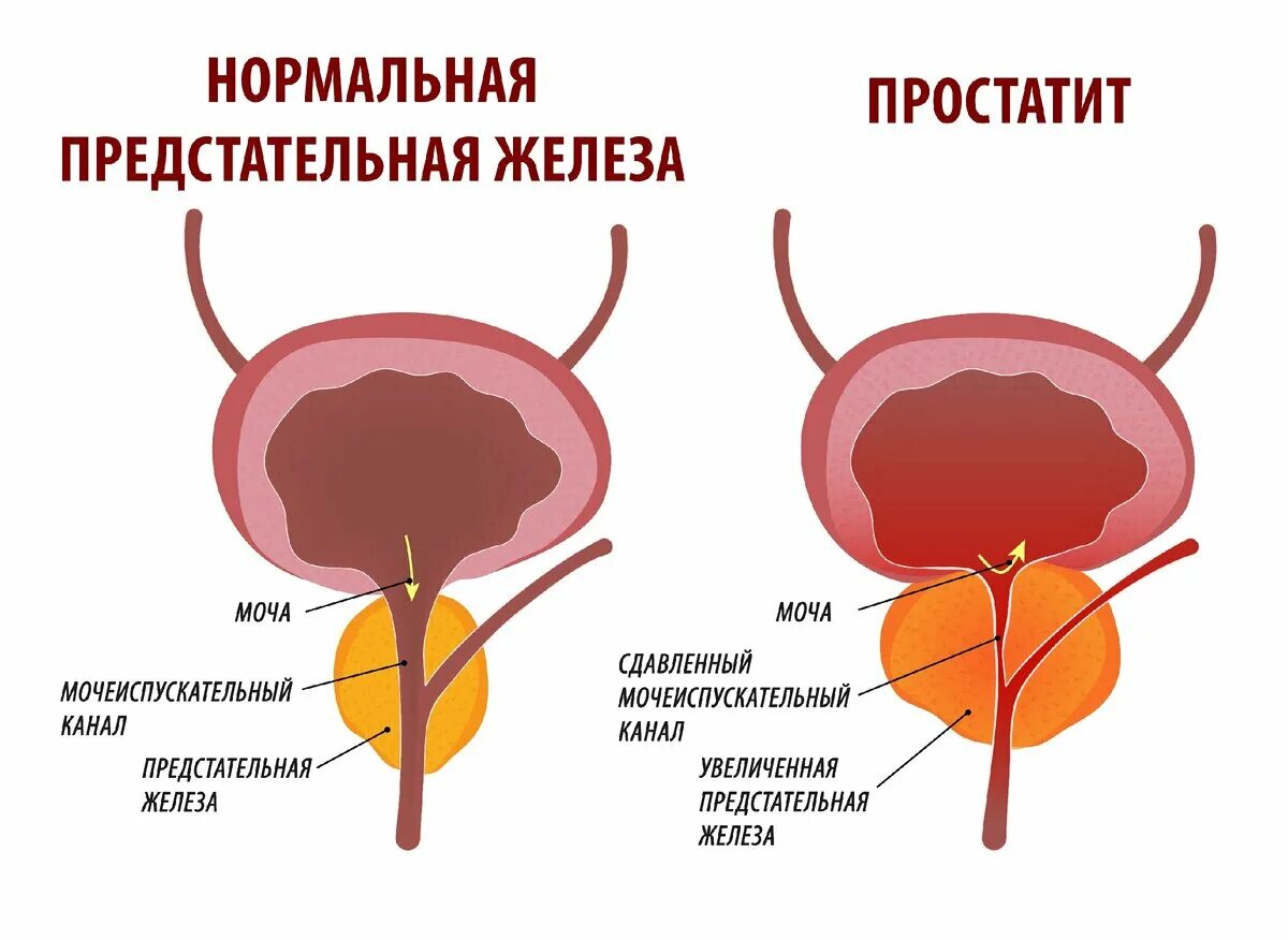 Простата это простыми словами фото у мужчин Как распознать простатит? Доктор ЕЛАМЕД Дзен