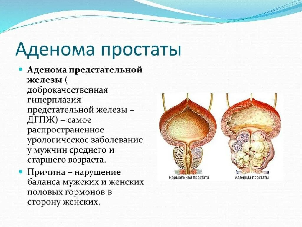 Простата это простыми словами фото у мужчин Аденома простаты лечение сколько