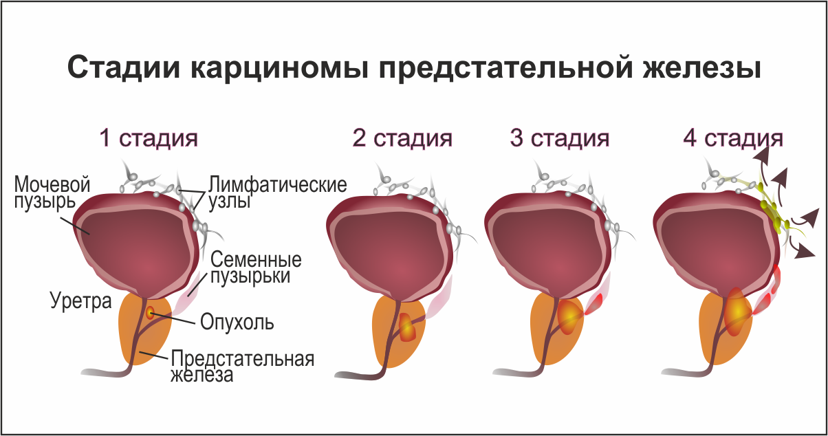 Простата это простыми словами фото у мужчин Рак предстательной железы (простаты) - Telegraph