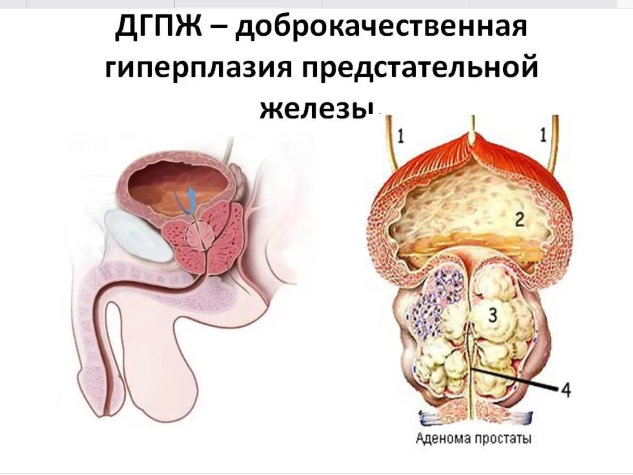 Простата симптомы фото Дгпж предстательной что это