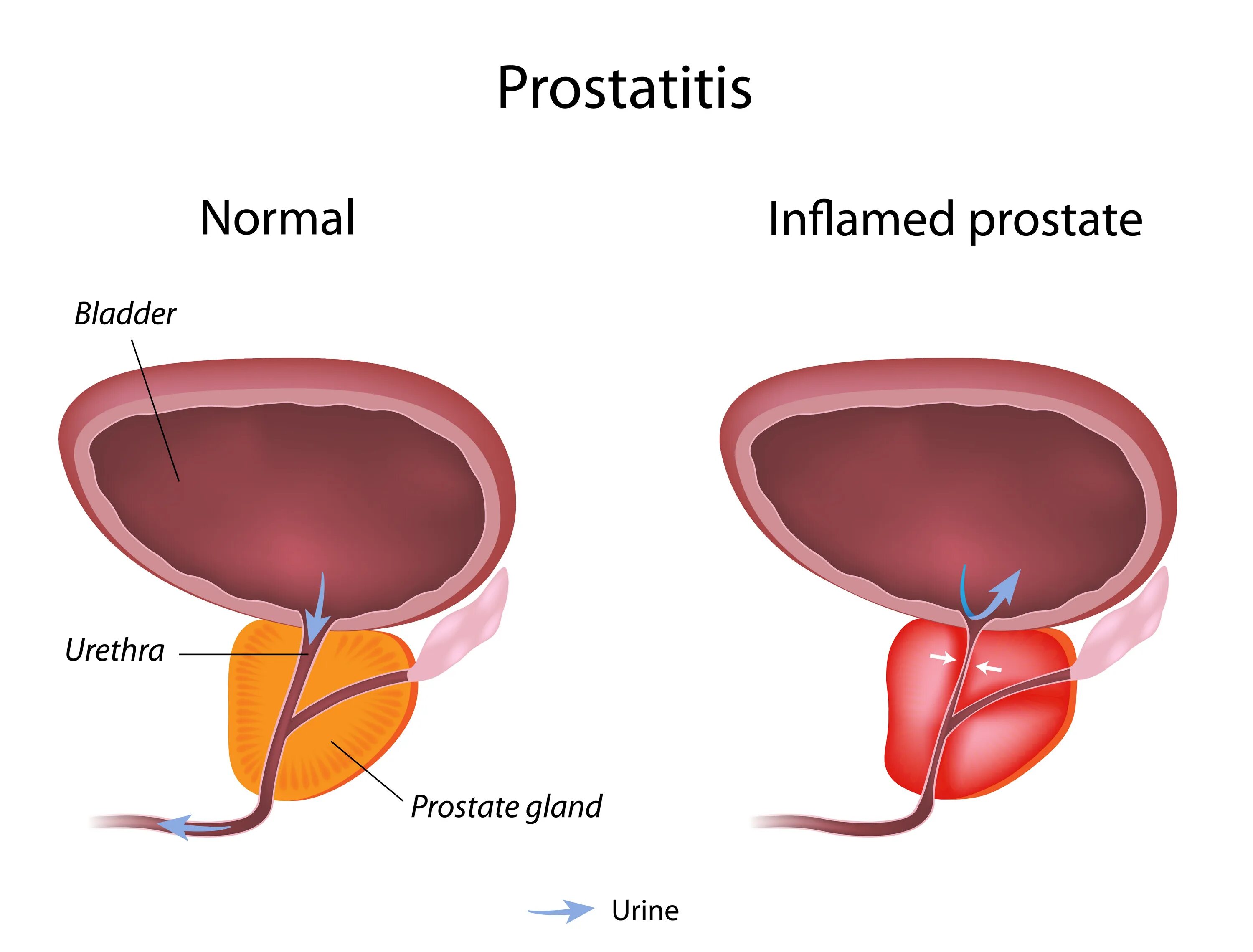 Простата симптомы фото Erectile Dysfunction And Cloudy Urine Hot Sale poligraf-ti.kz