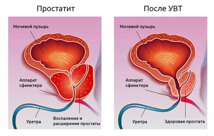 Простата симптомы фото Ударно волновая терапия при простатите УВТ, лечение, цена