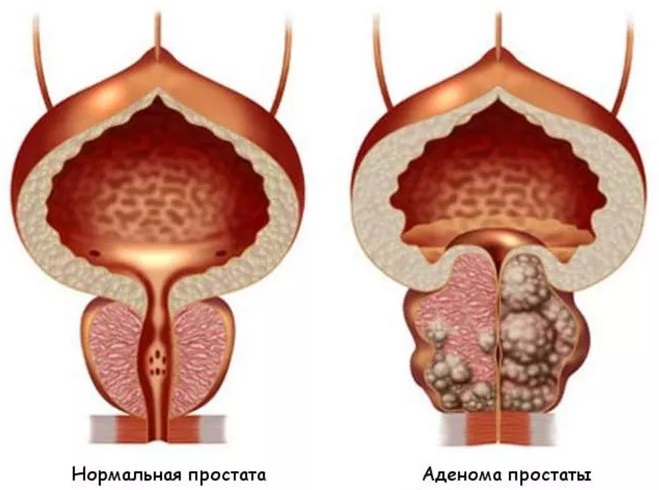 Простата симптомы у мужчин фото Аденома простаты: симптомы и лечение аденомы предстательной железы в ФНКЦ