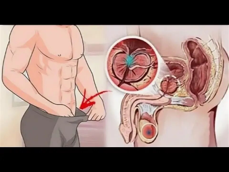 Простата симптомы у мужчин фото 12 symptômes avant-coureurs du cancer de la prostate que tous les hommes doivent