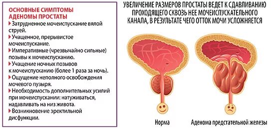 Простата симптомы у мужчин фото Гиперплазия предстательной железы что это лечение: найдено 77 изображений