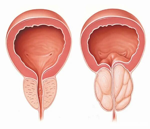 Простата снаружи фото Гиперплазия предстательной железы: что это такое у мужчин, стадии ДГПЖ и аденомы