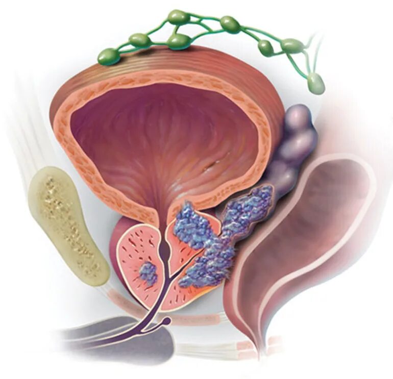 Простата у мужчин что это такое фото Рак простаты