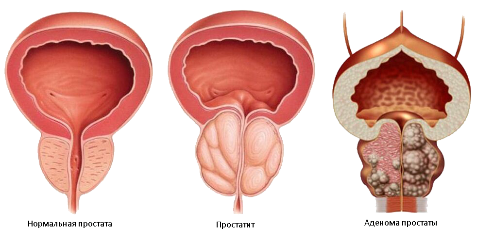 Простата у мужчин что это такое фото Лечение рака предстательной железы в клинике OncoCareClinic 308