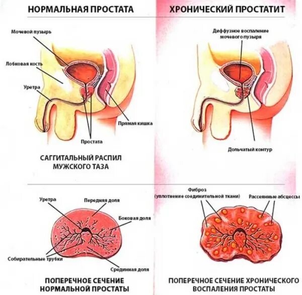 Простата у мужчин что это такое фото Признаки появления хронического Простатита - Симптомы и лечение