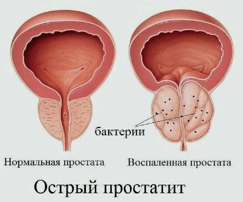 Простата у мужчин что это такое фото ПРОСТАТИТ - чума 21 века? - Ильдар Шарипов на TenChat.ru