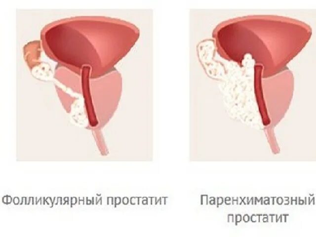 Простатит симптомы фото Есть ли при простатите выделения: Выделения из уретры как признак простатита - М