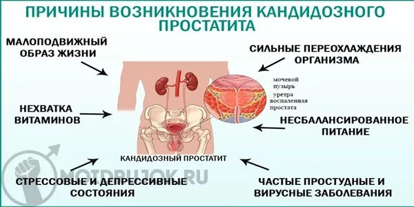 Простатиты симптомы мужчин лечение фото Как снять воспаление простаты от переохлаждения - фото презентация