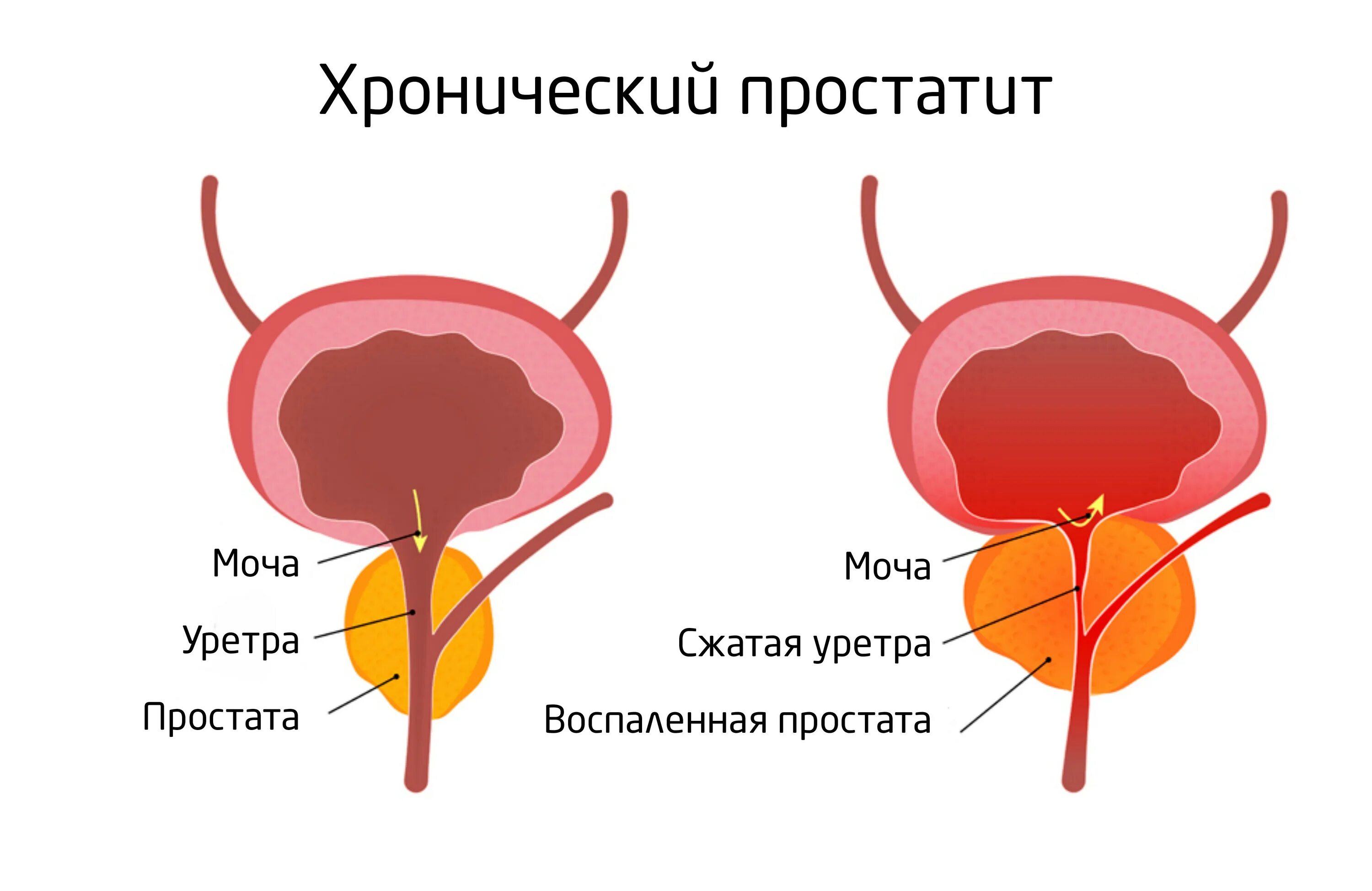 Простатиты симптомы мужчин лечение фото Хронический простатит Симптомы, причины, лечение у мужчин ᐉ Гармония здоровья