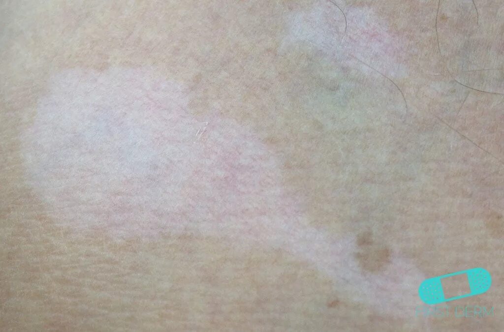 Простой белый лишай фото Vitiligo - Online Dermatology