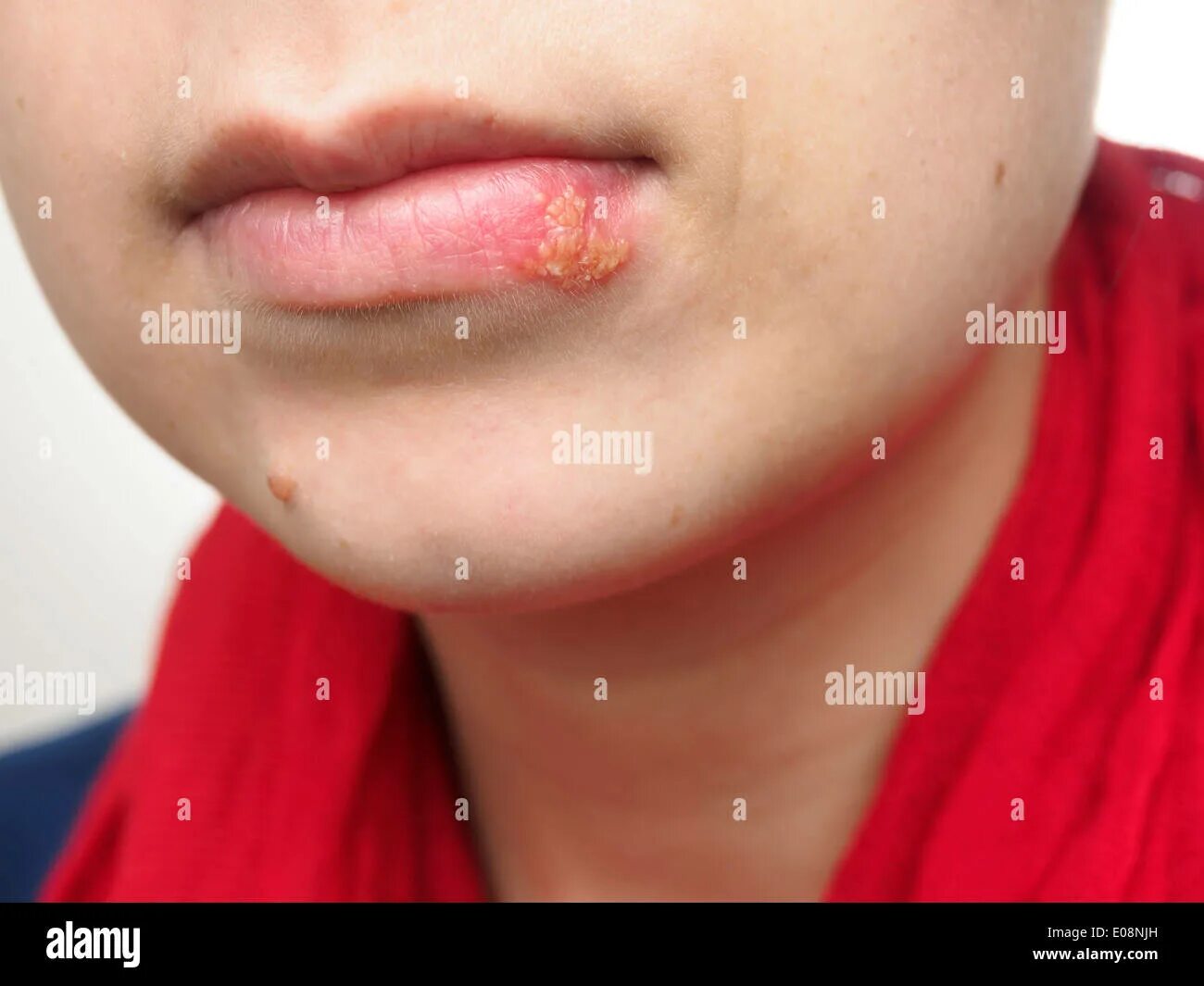 Простой герпес фото на теле Junge Frau mit Herpes-Simplex-Infektion an Unterlippe Stockfotografie - Alamy