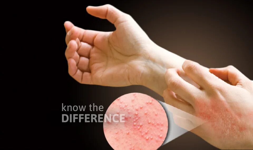 Простой контактный дерматит фото Taiwan Know The Difference - not all skin reaction is an allergy