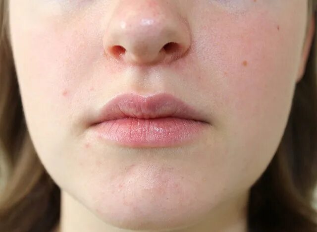 Простые дерматиты фото Category:Perioral dermatitis - Wikimedia Commons