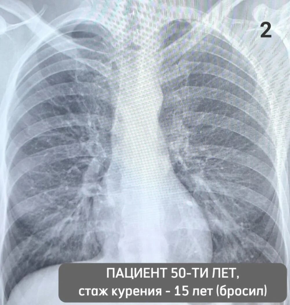 Простые легкие фото Сегодня Всемирный день без табака / Набережные Челны