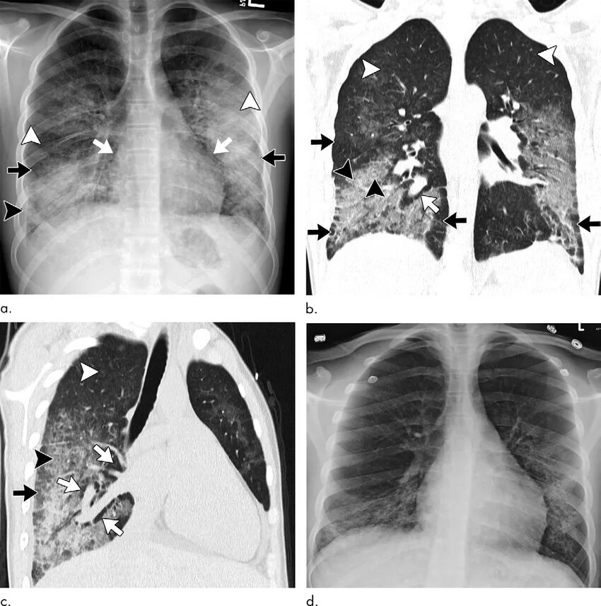 Простые легкие фото Images show electronic cigarette or vaping product use-associated lung... Downlo