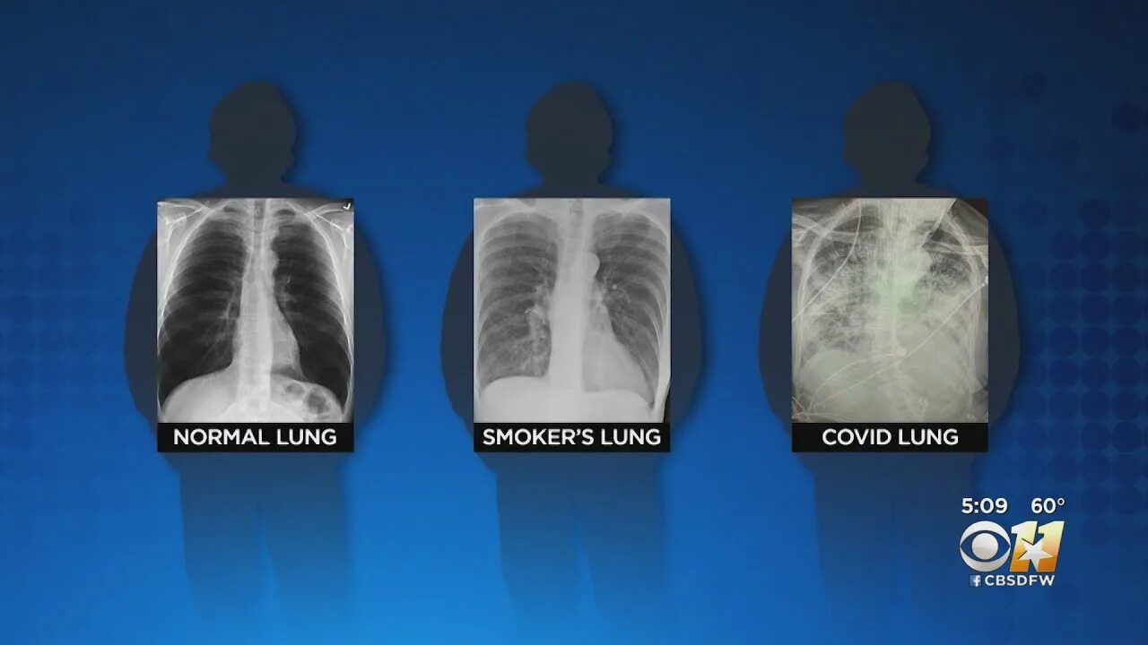 Простые легкие фото Texas Trauma Surgeon Gives Look At Long-Term Effects Of COVID-19 On Lungs - YouT