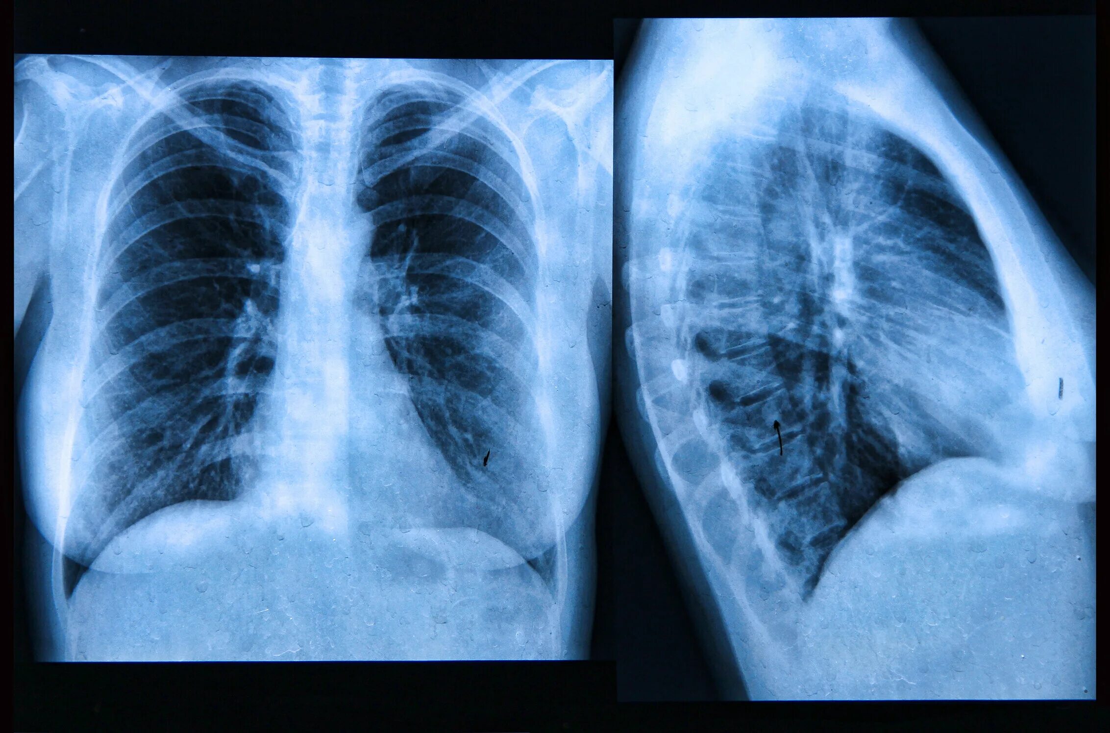 Простые легкие фото Patients with Idiopathic pulmonary fibrosis have a different composition of micr