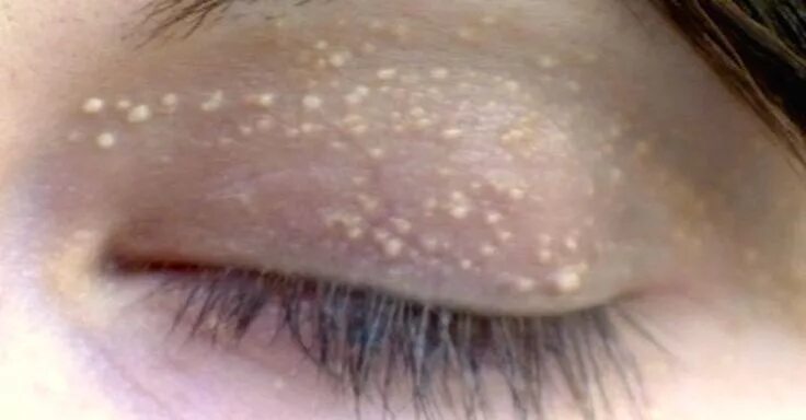 Просянка на веке фото как лечить Strange Bumps Affect Millions, But Treating Them Is As Simple As Rubbing Honey O