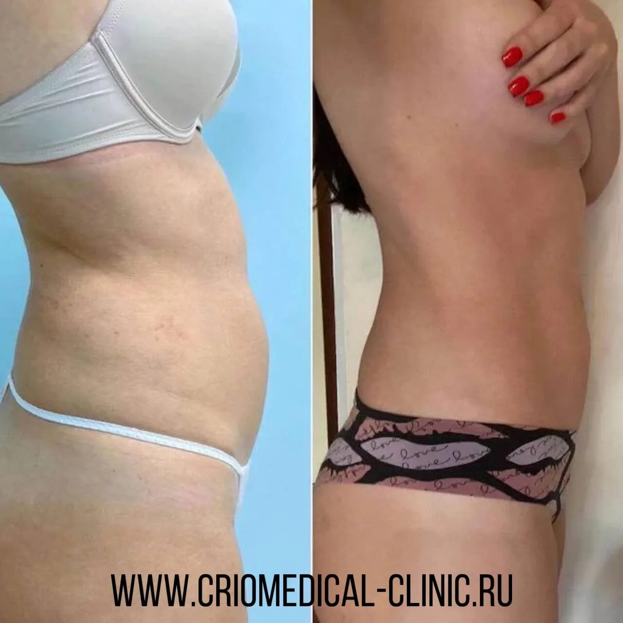 Процедура криолиполиза фото до и после Cosmo Beauty Criomedical Clinic Екатеринбург ონალინ ჩაწერა