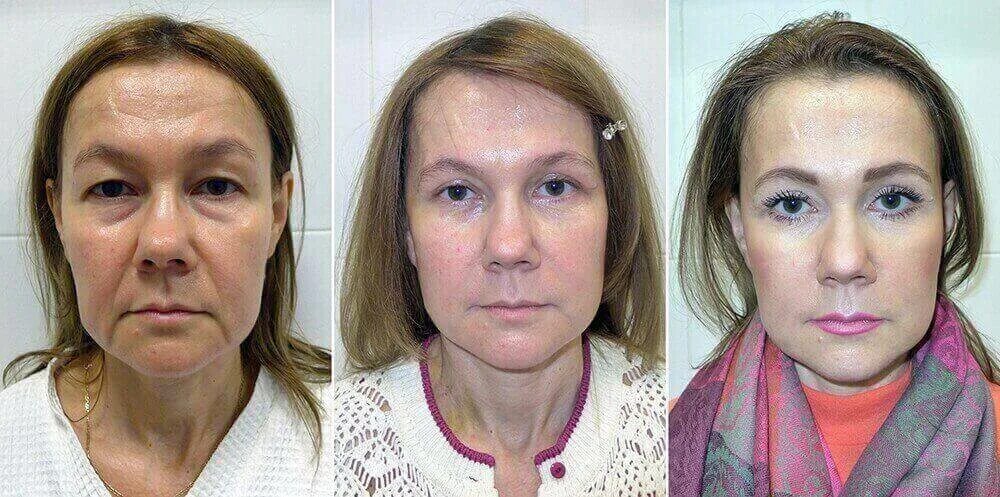 Процедура смас фото до и после SMAS face lifting - Coolaser Clinic