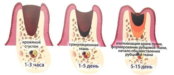 Процесс удаления зуба фото Восстановление после удаления зуба - Пушкино: этапы, варианты