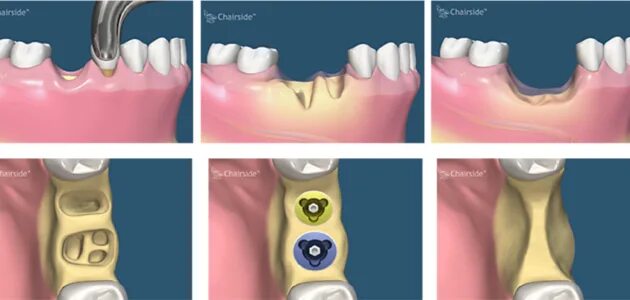 Процесс удаления зуба фото Состояние после экстракции зуба карта вызова