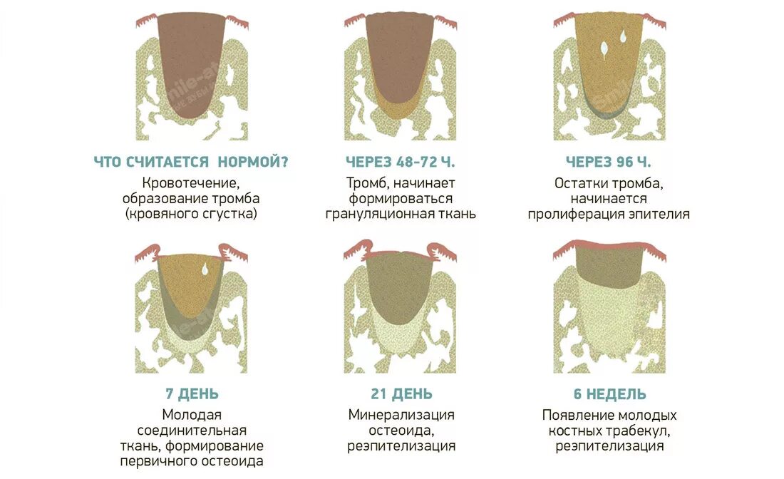 Процесс удаления зуба фото Как заживают зубы после удаления - Стоматология Северное Бутово Делия только кач