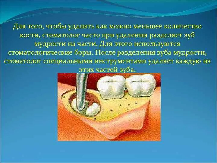 Процесс удаления зуба фото Через сколько можно полоскать зуб после удаления