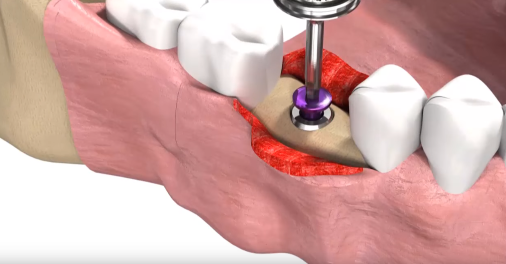 Процесс установки импланта пошагово с фото Имплантация жевательного зуба - особенности, методики, этапы