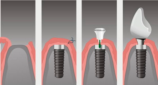 Процесс установки импланта пошагово с фото Зубные импланты: как их ставят и больно ли это complex-clinic.ru