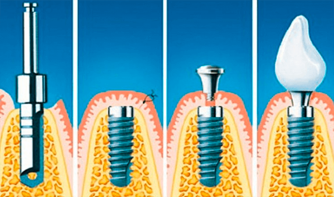 Процесс установки импланта пошагово с фото Имплантация зубов под ключ в Москве - цена Стоматология "Французский стандарт"