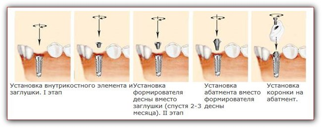 Сравнение одноэтапной и двухэтапной методики имплантации зубов. Доступная стомат