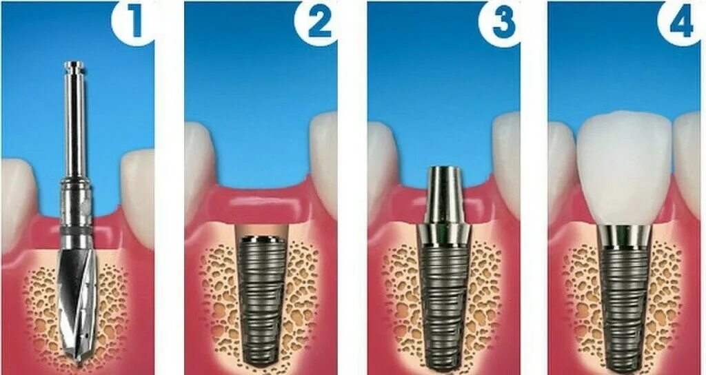 Процесс установки импланта пошагово с фото Импланты зубов - рейтинг производителей, зачем нужны, фото