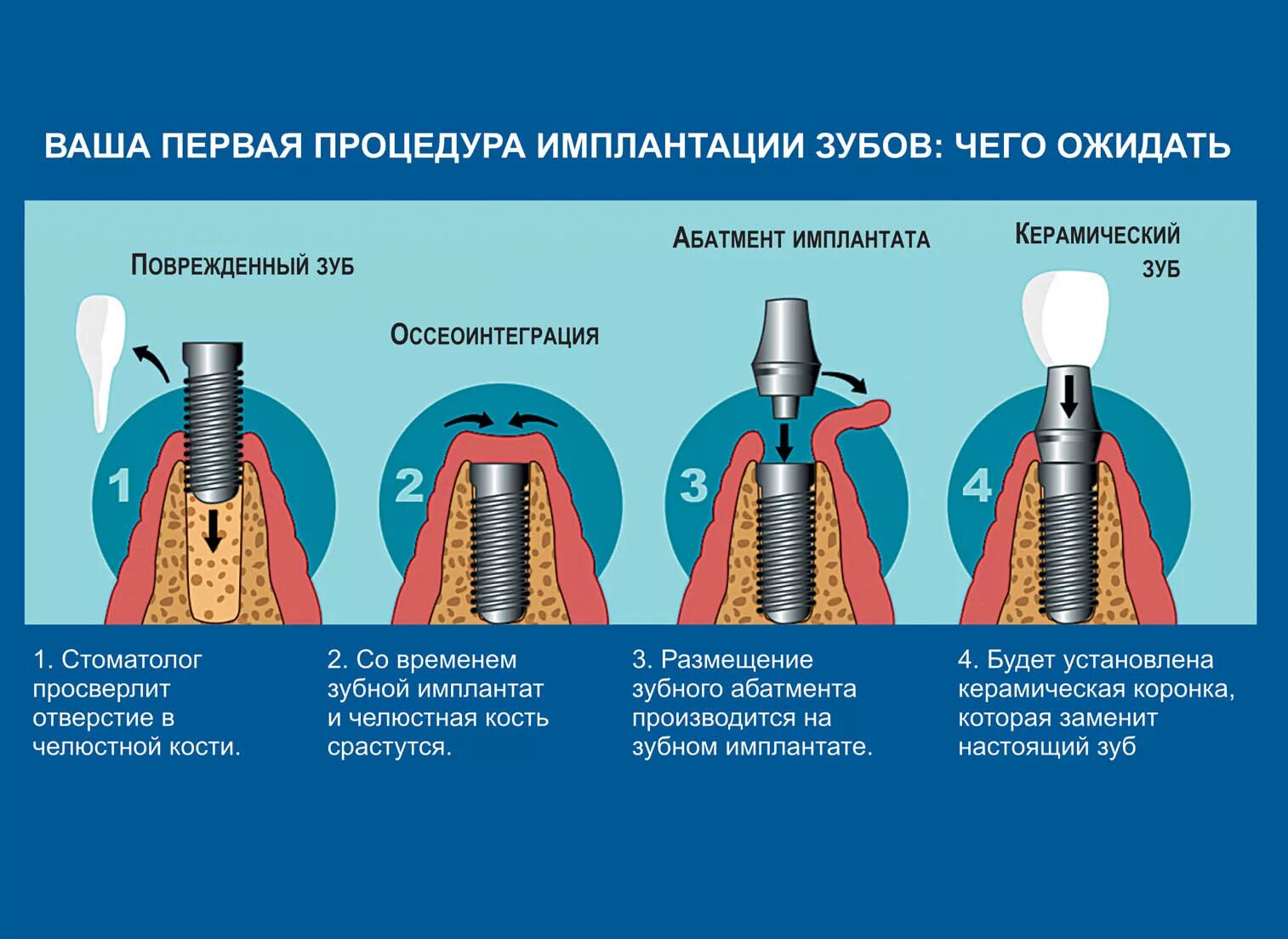 Процесс установки импланта пошагово с фото Имплантация описание