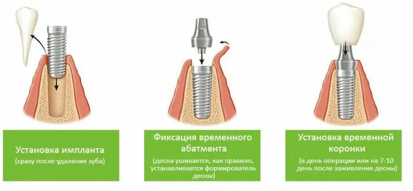 Процесс установки импланта пошагово с фото Имплантация после удаления зуба - Cтоматология Май